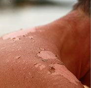 Sun exposure on unprotected skin during outdoor activity